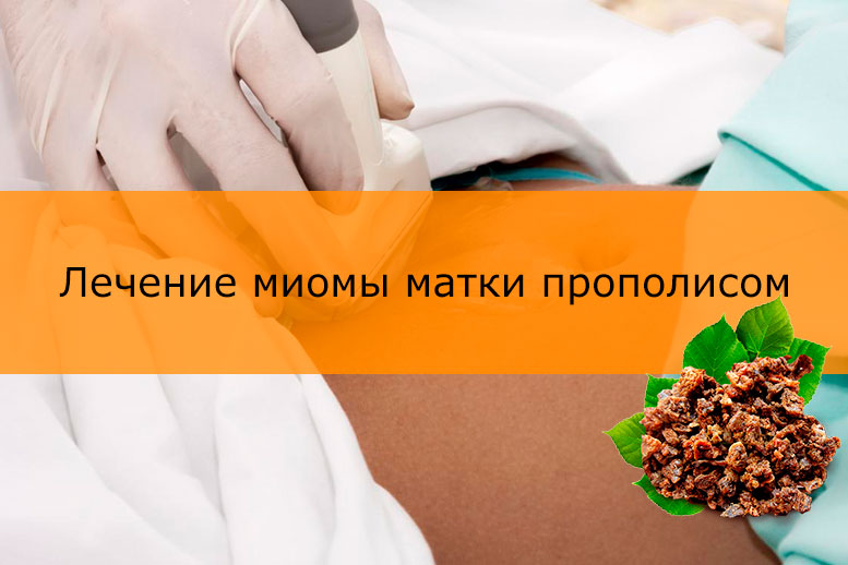 Прополис при миоме матки как применять (рецепты) противопоказания