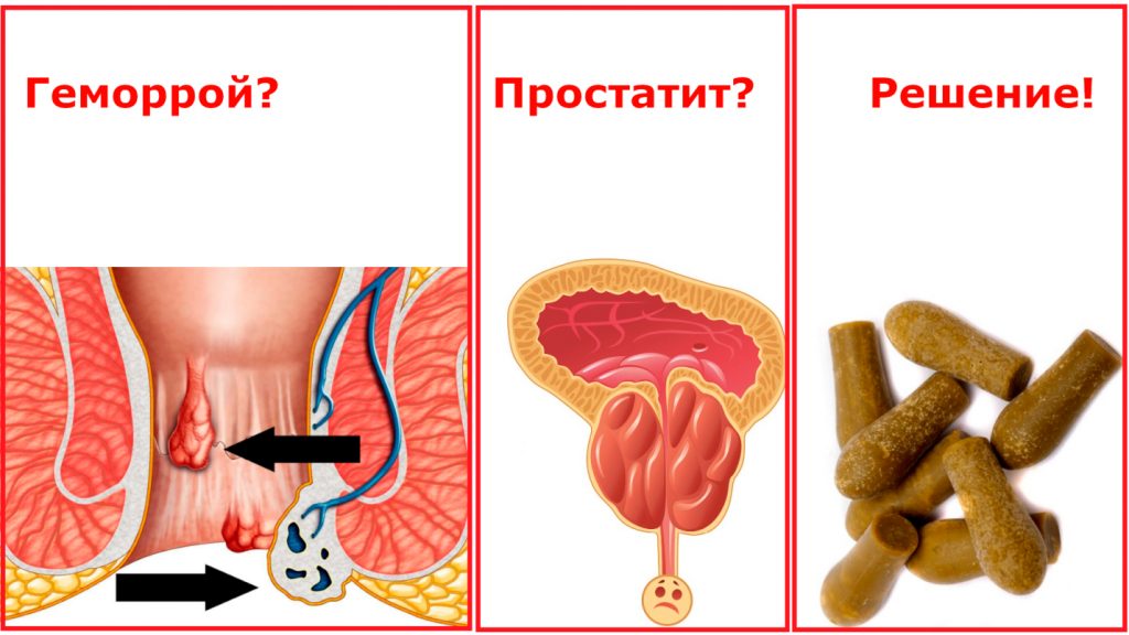 Прополис при геморрое и простатите Прополис при геморрое и простатите
